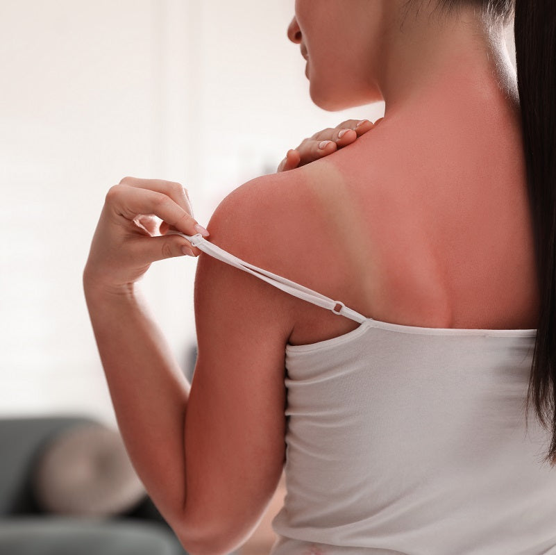 Women with a back sunburn